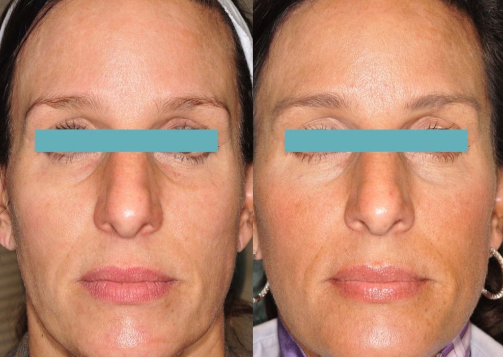 Sculptra Before and After Picture